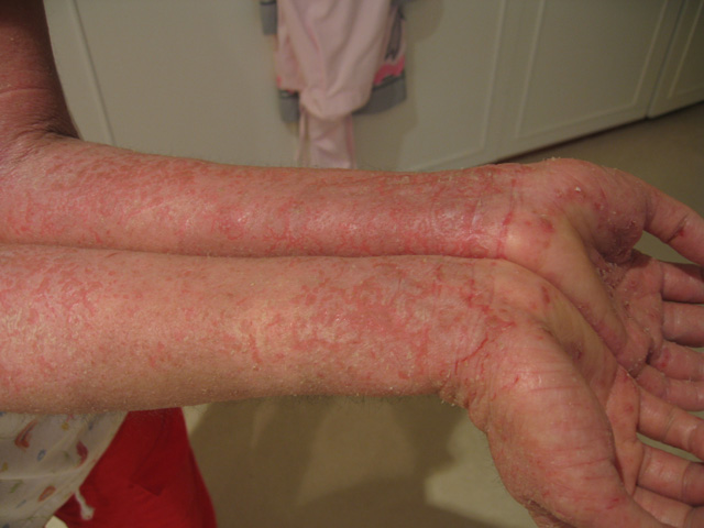 Person with eczema on their forearms
