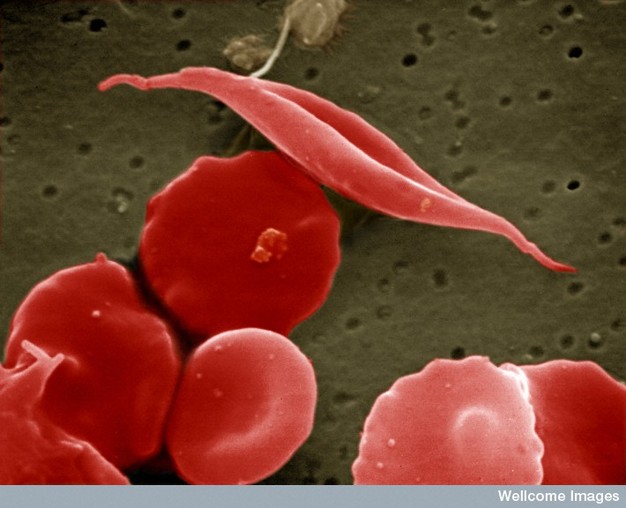 Photo showing Sickled Red Blood Cell in Sickle Cell Anemia