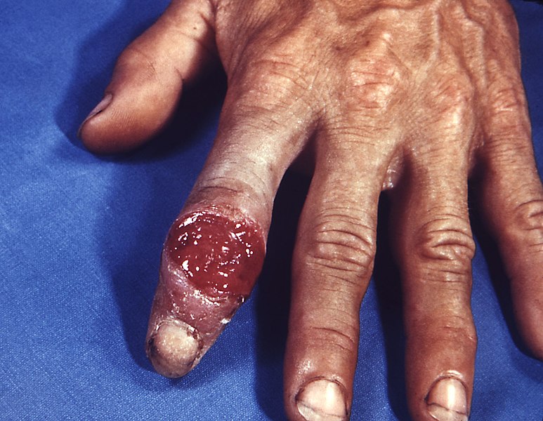Image showing a syphilis chancre on the index finger