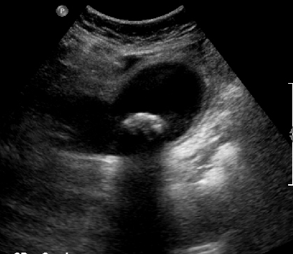 Ultrasound image showing Gallstone in the Gallbladder