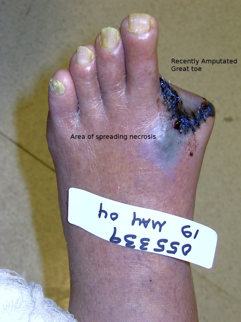 Photo showing early gangrene following amputation of a big toe