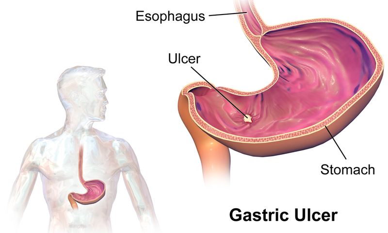 Illustration showing gastric ulcer with labels for major locations and parts