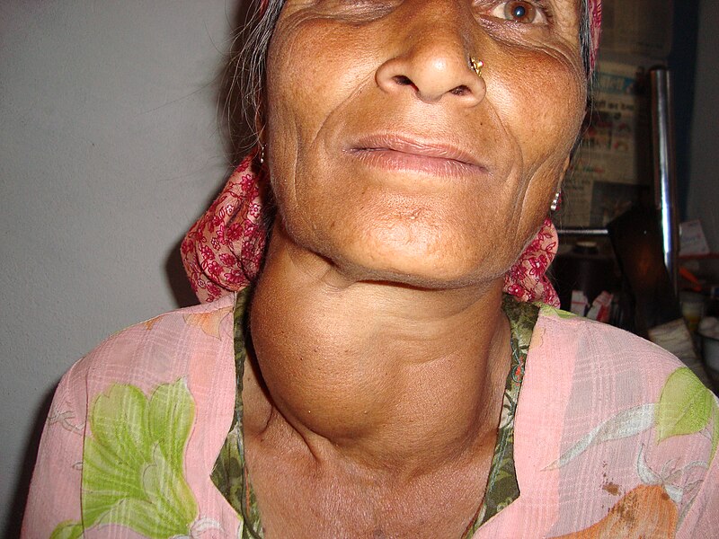 Image showing a person with a goiter
