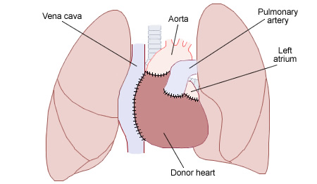 Illustration showing a heart transplant with text labels for major parts