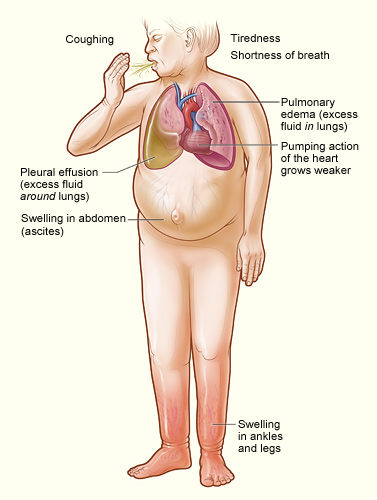 Illustration showing symptoms of heart failure on a human figure, with labels