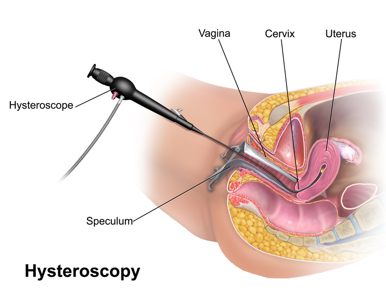 Illustration showing a hysteroscopy procedure