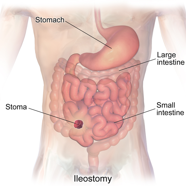 Illustration showing ileostomy and stoma with labels for major parts