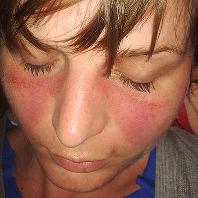 Image showing a person with a Butterfly Rash on the Face Associated With Lupus