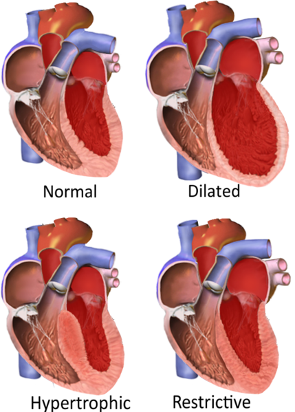 Illustration showing Categories of Cardiomyopathy