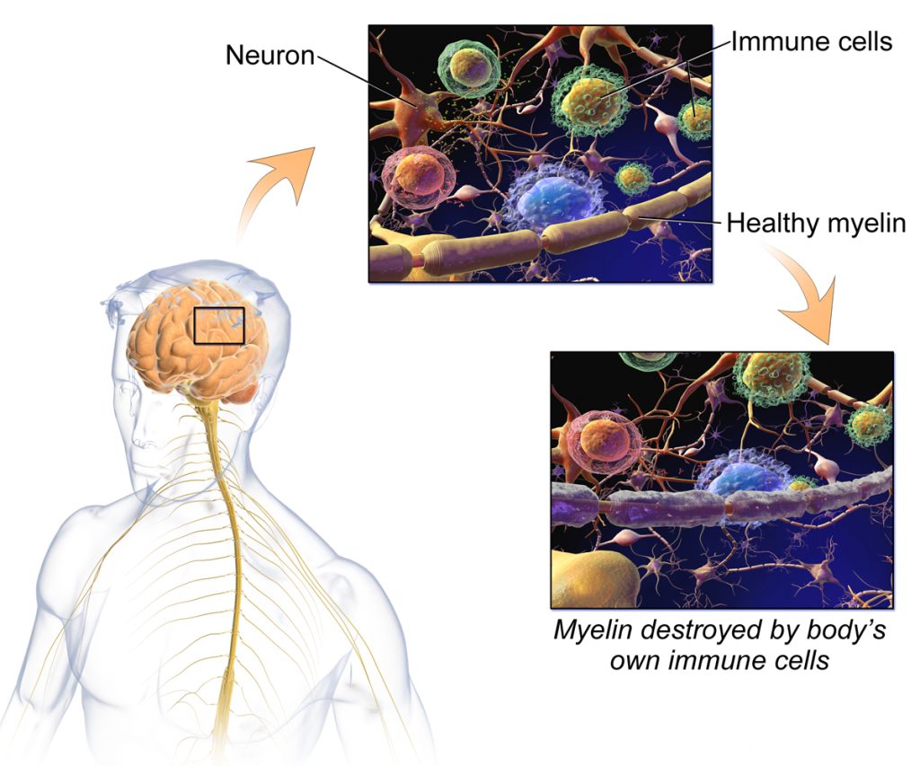 Images showing Multiple Sclerosis impact on brain