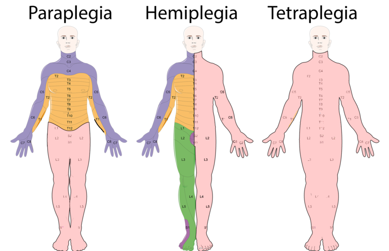 Illustration showing Paraplegia, Hemiplegia, and Tetraplegia (Quadriplegia) in three human figures