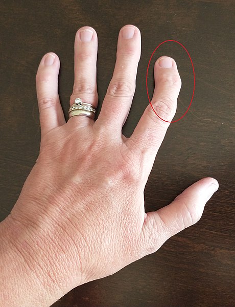 Image showing Osteoarthritis in the Hand on a person's index finger