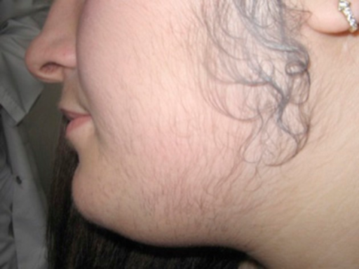 Image showing a person with hirsutism