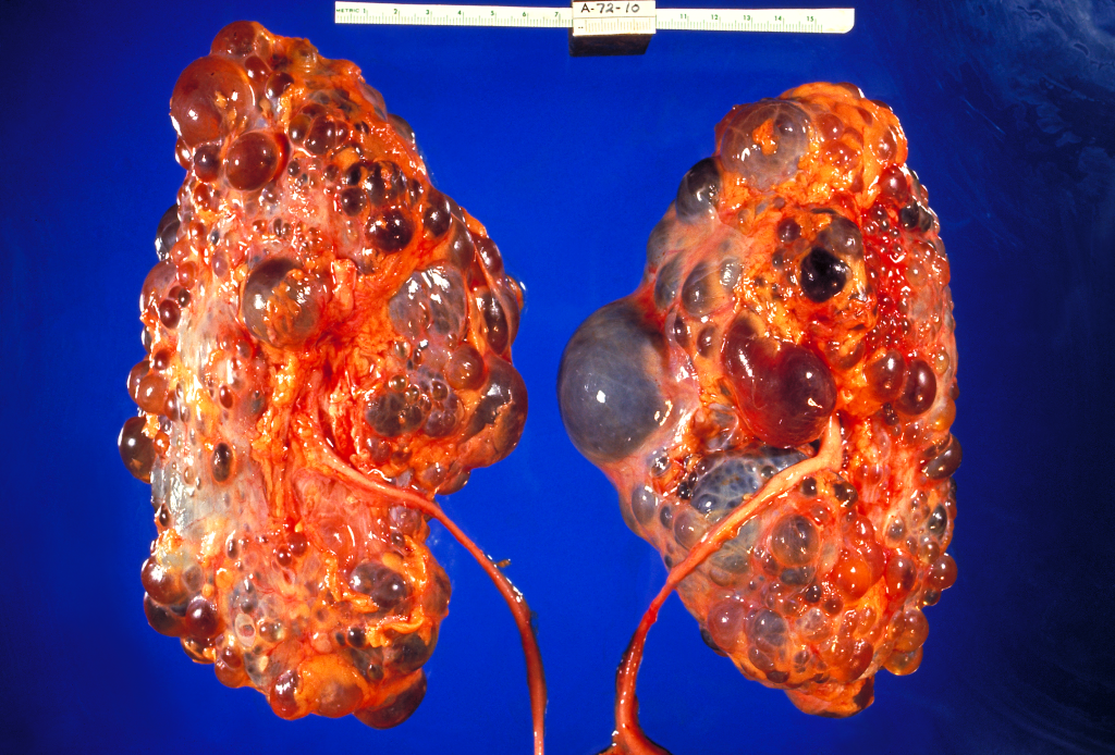 Image showing kidneys with polycystic kidney disease