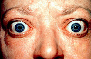 Image showing someone with symptoms of exophthalmos