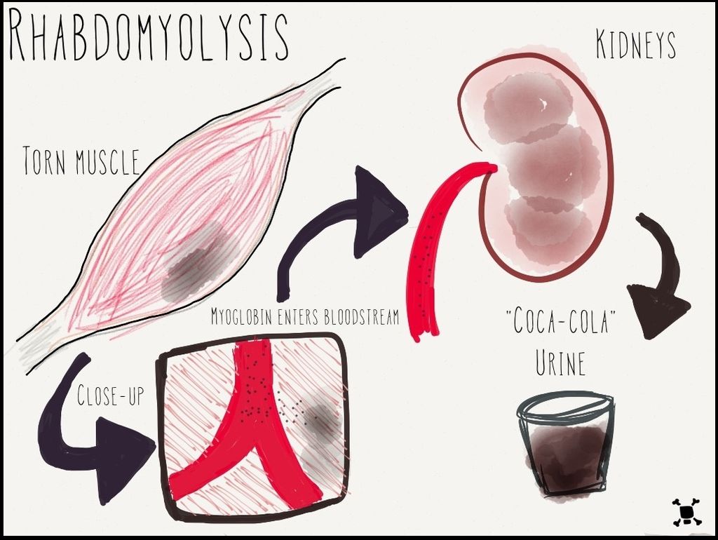 Illustration showing process that causes rhabdomyolysis