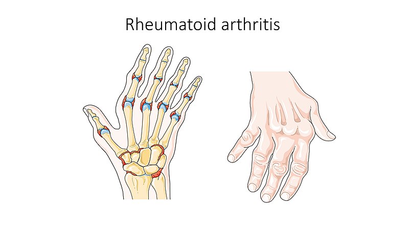 Illustration showing hand and skeletal makeup of someone with rheumatoid arthritis