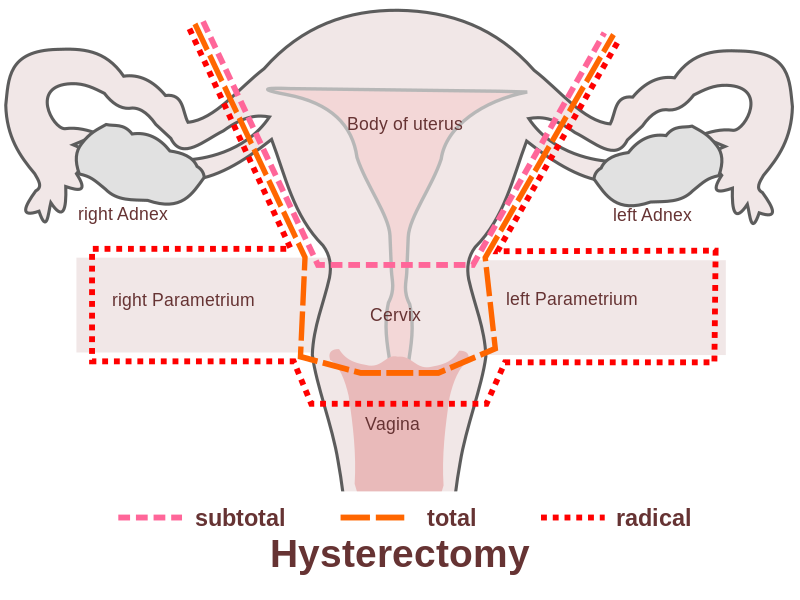 Illustration showing different types of hysterectomies