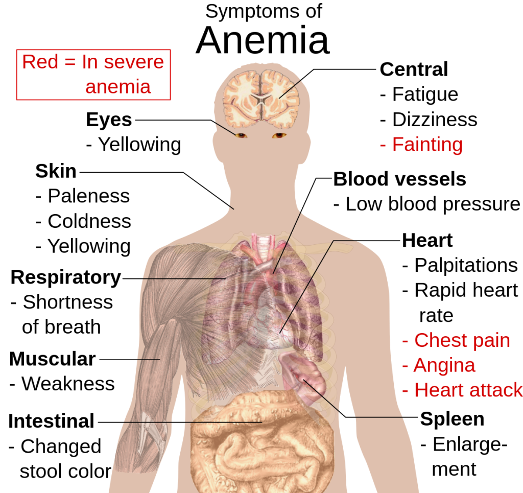Illustration labeling symptoms of anemia on a human figure with text labels