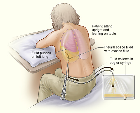 Illustration, with textual labels showing a patient with thoracentesis