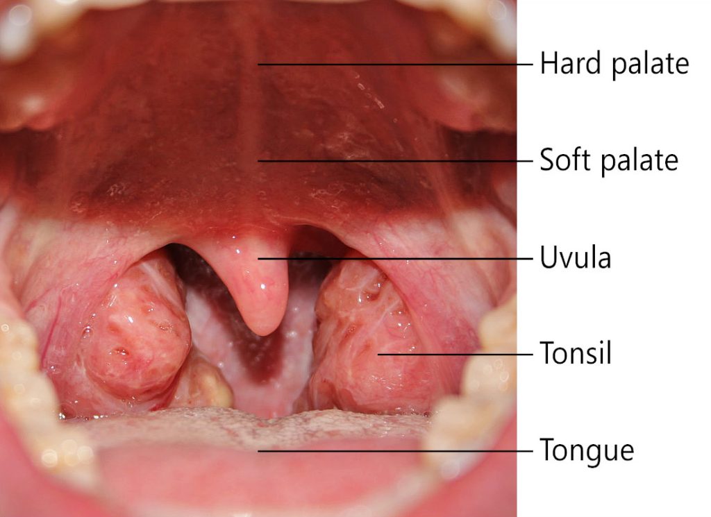 Image showing location of tonsils, with labels for other major oral cavity parts. Tonsils in picture are swollen.