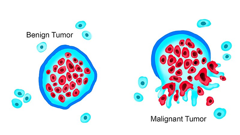 Illustration showing both benign and malignant tumors