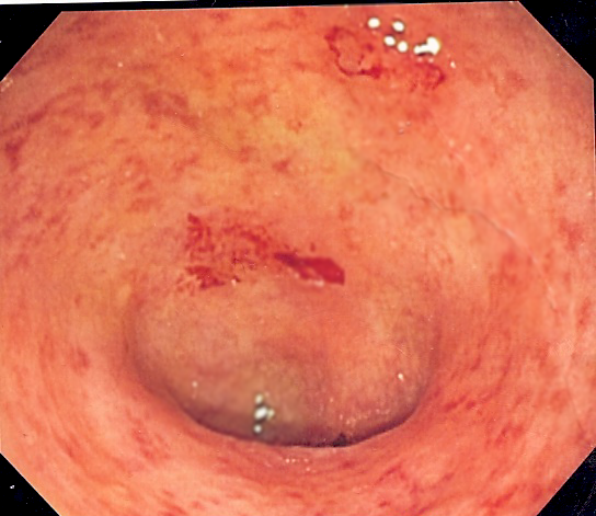 Image showing granularity related to ulcerative colitis