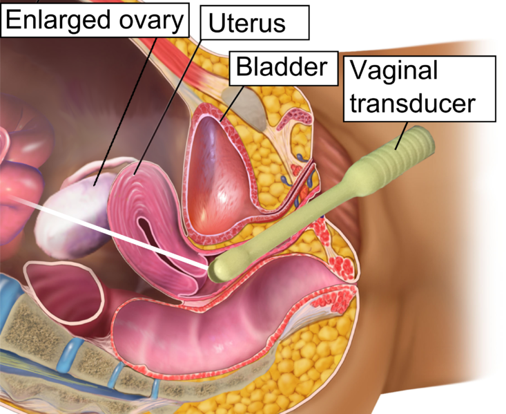Image showing a transvaginal ultrasound, with labels