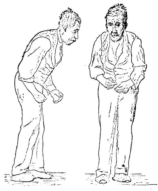 Illustration showing an elderly man with Parkinson's disease