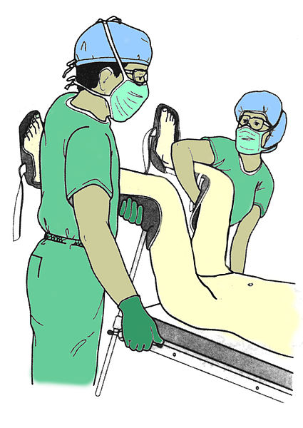 Illustration showing two medical workers holding a patient's legs in lithotomy position