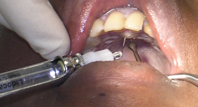 Image showing the administration of Local Anesthesia During a Dental Procedure