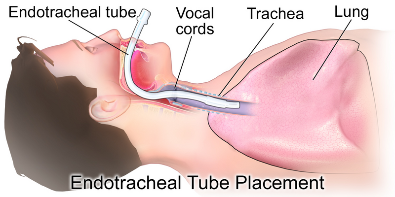 Illustration showing internal endotracheal tube placement with textual labels