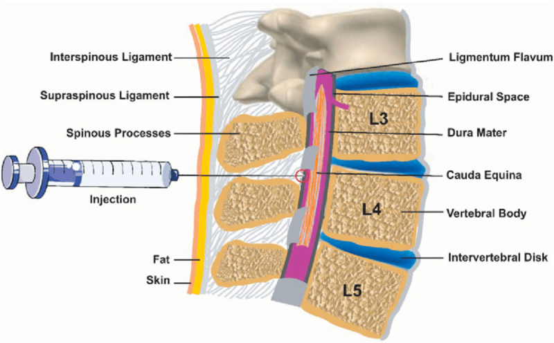 Illustration showing an epidural block with text labels for anatomical areas along the spine and injection site