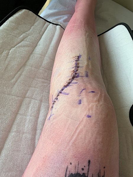 Image showing a surgical site on a patient's leg