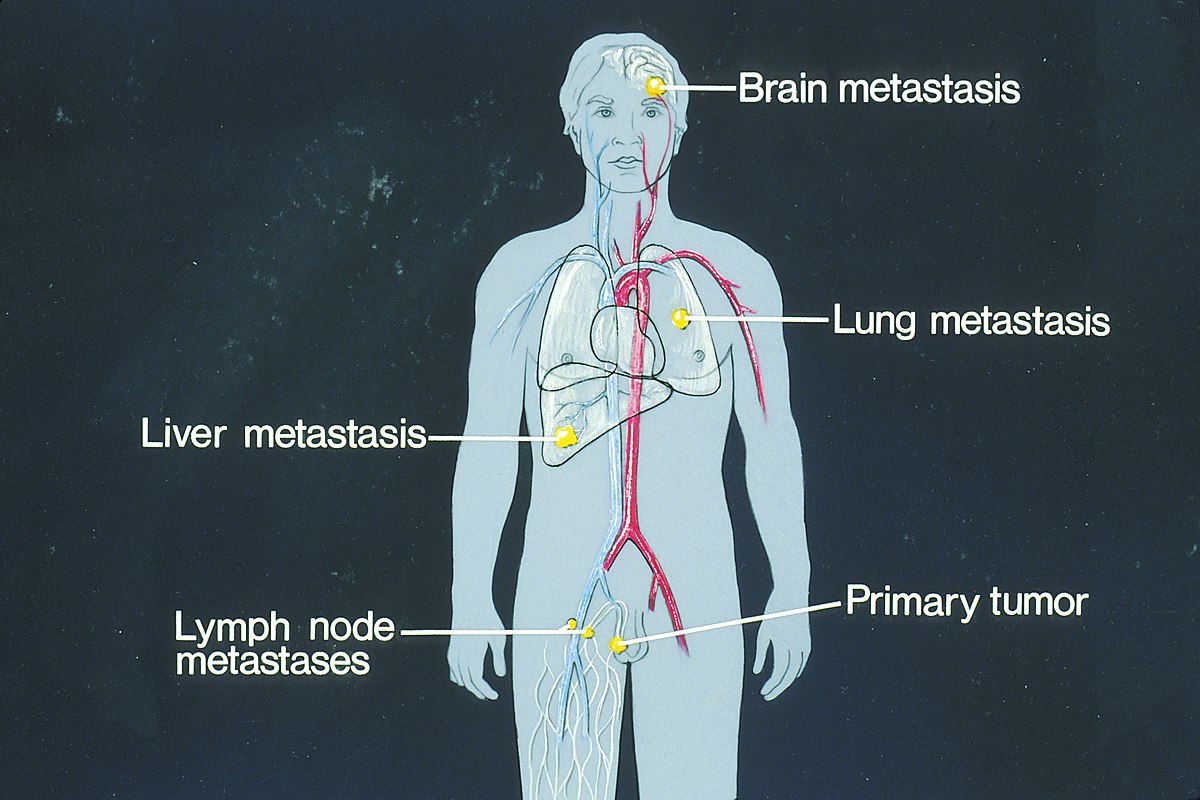 Illustration showing a human figure with various forms of metastasis types and locations indicated with text labels