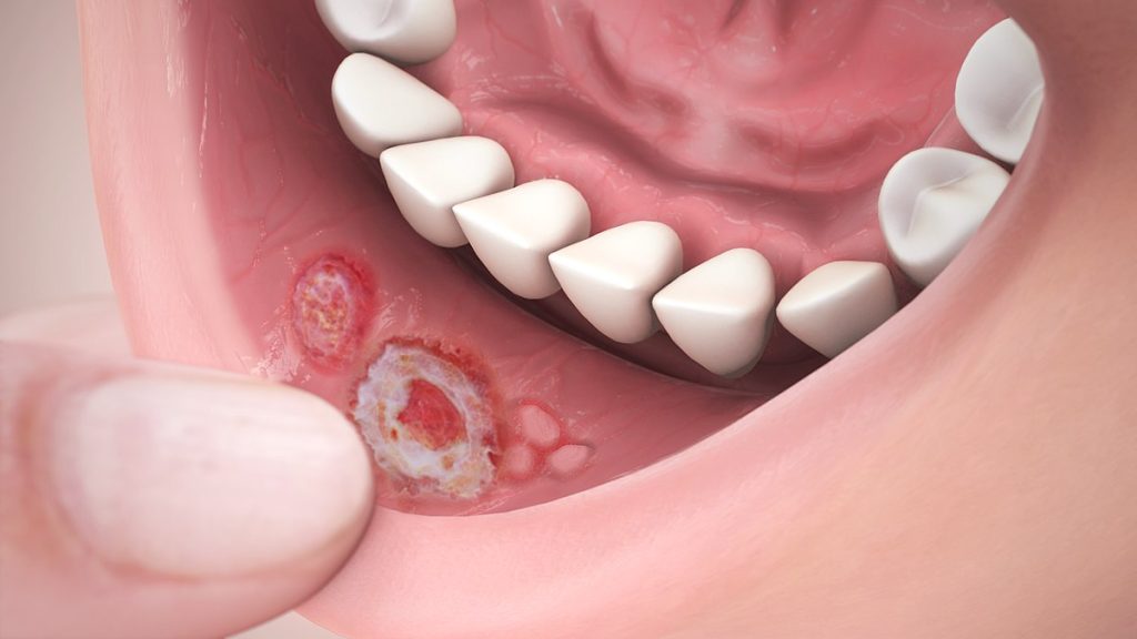 Illustration showing stomatitis inside the lower lip of a human mouth