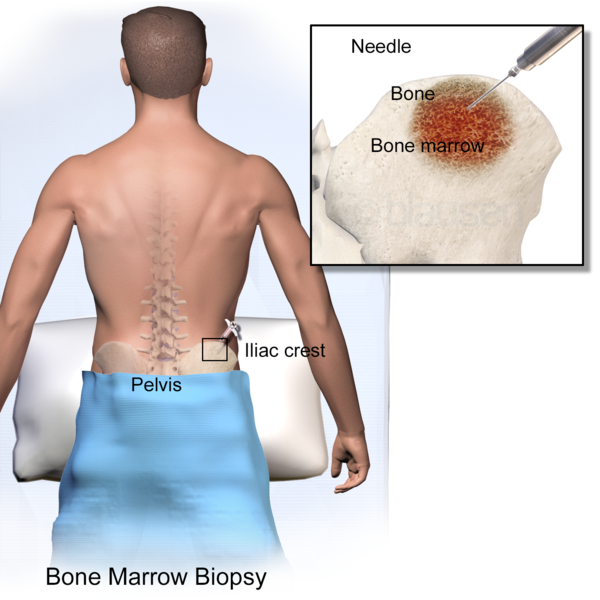 Illustration showing the site of a bone marrow biopsy with an inset showing internal positioning of needle into bone marrow