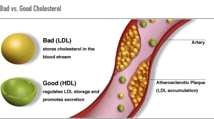 Illustration showing Atherosclerotic Plaque in an Artery Caused By LDL