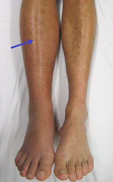 Image showing a patient's leg showing signs of deep vein thrombosis, where one leg is red and swollen compared with other leg