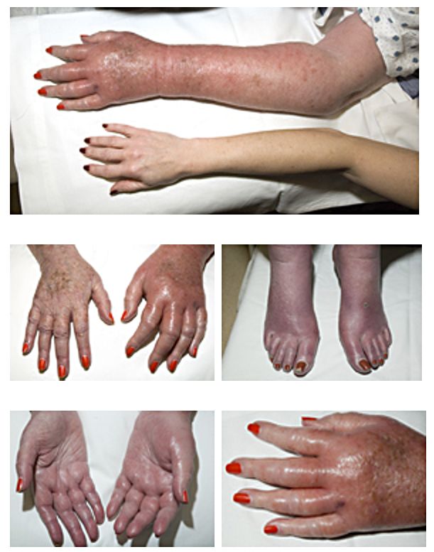 Image showing Erythromelalgia in hands, feet, and arms of a patient