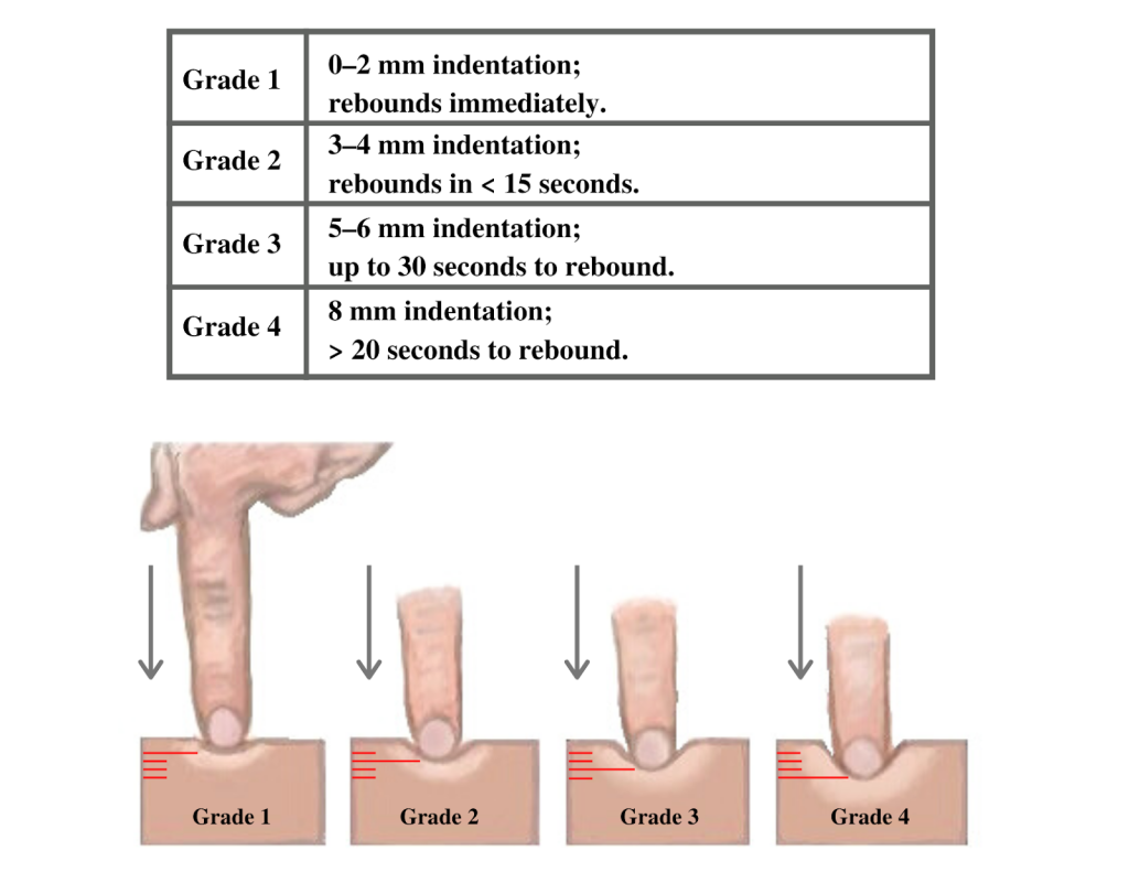 Image showing table and corresponding illustration of finger pushing on skin for assessing edema in four grades
