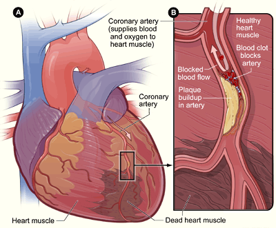 Illustration showing a myocardial infarction