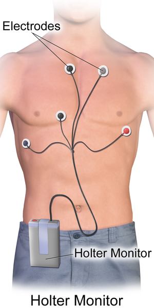 Illustration showing a patient wearing a Holter Monitor with text labels for the electrodes and monitor
