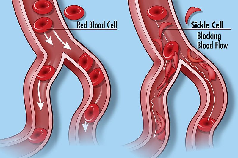 Illustration showing sickle cells blocking blood flow within blood vessel