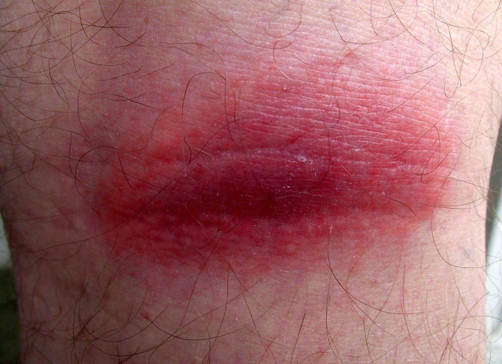 Image showing a closeup of inflammation on the skin caused by a tick bite