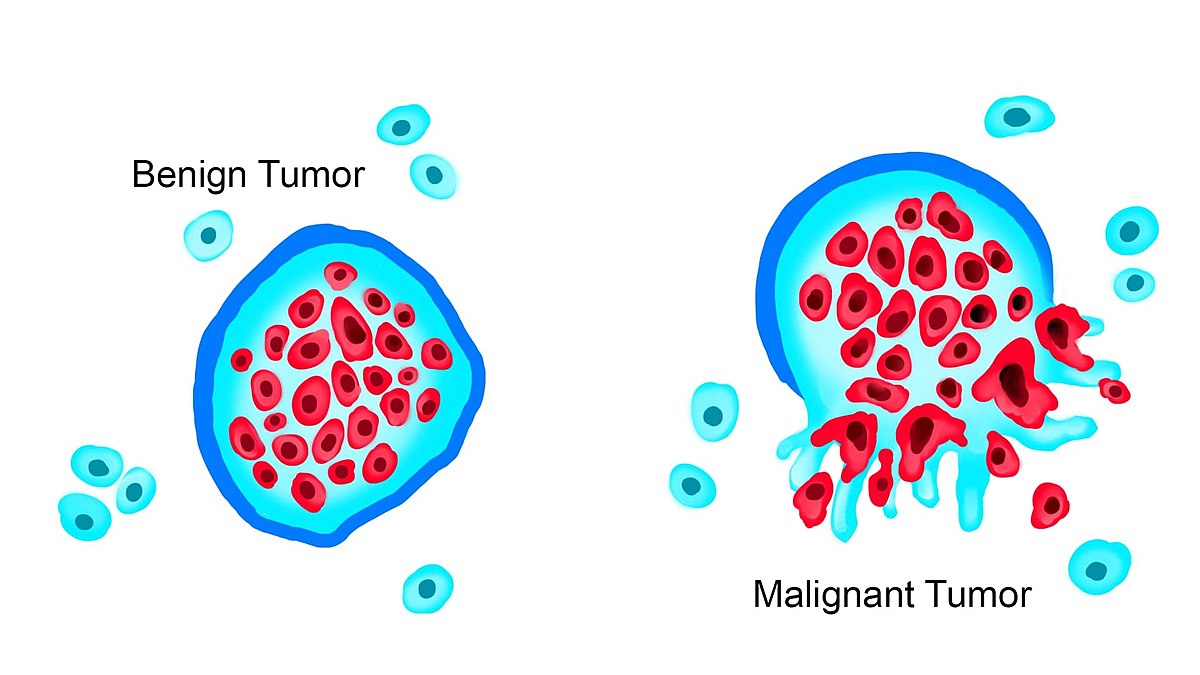 Illustration showing a benign and a malignant tumor
