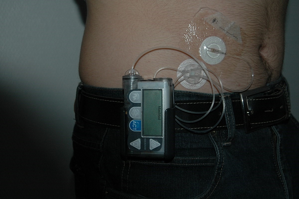 Image showing a Insulin Pump and Continuous Glucose Monitoring System located on a person's abdomen
