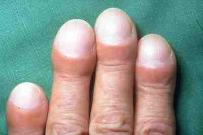 Image showing clubbing of nailbeds due to chronic hypoxia