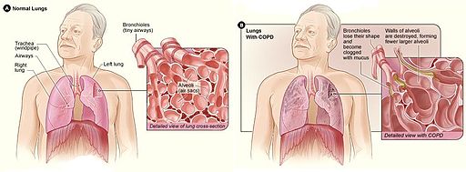 Illustration showing a comparison between normal lungs and those with chromic obstructive pulmonary disease