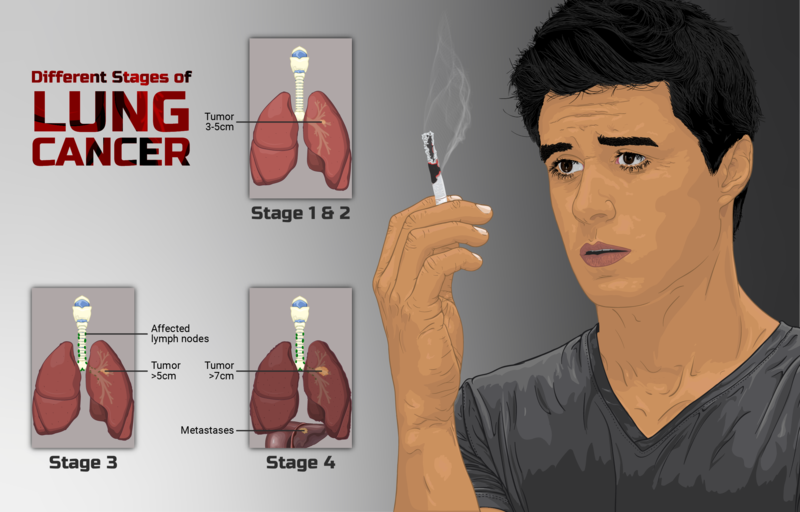 Image showing a person holding a cigarette with three call out boxes showing different stages of lung cancer, with text labels for sizes of tumors